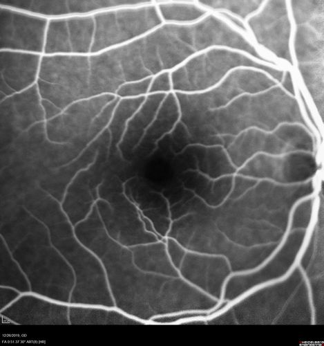 Normal Eye - Vision 20/16
61 year old female with multiple problems including chronic CME in the left eye.
