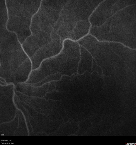 Cystoid Macular Edema and Macular Pucker
has been particular bad for 3 years.  She has a macular pucker and severe CME.

VA 20/160 left eye
