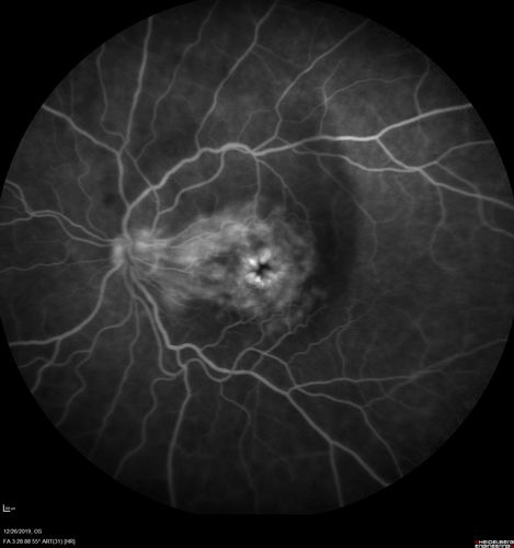 Cystoid Macular Edema and Macular Pucker
has been particular bad for 3 years.  She has a macular pucker and severe CME.

VA 20/160 left eye
