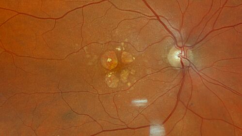 Wet AMD - Occult CNVM and Geographic atrophy
77 year old female with mild vision loss - 20/32 - responded to Avastin
