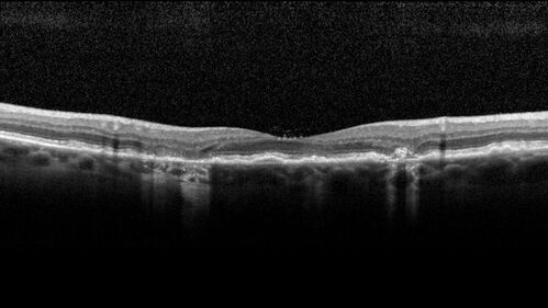 Wet AMD - Occult CNVM and Geographic atrophy
77 year old female with mild vision loss - 20/32 - responded to Avastin
