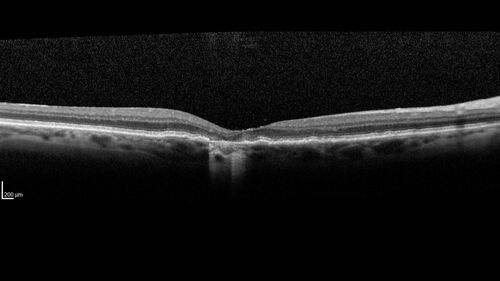 Wet AMD - Occult CNVM and Geographic atrophy
77 year old female with mild vision loss - 20/32 - responded to Avastin
