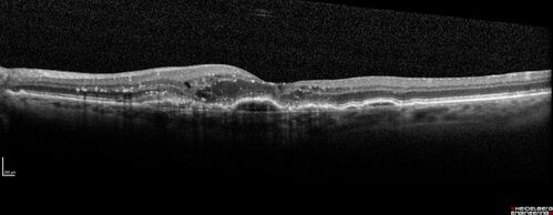 Wet AMD - Occult CNVM and Geographic atrophy
77 year old female with mild vision loss - 20/32 - responded to Avastin
