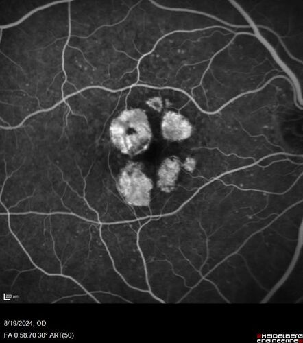Wet AMD - Occult CNVM and Geographic atrophy
77 year old female with mild vision loss - 20/32 - responded to Avastin
