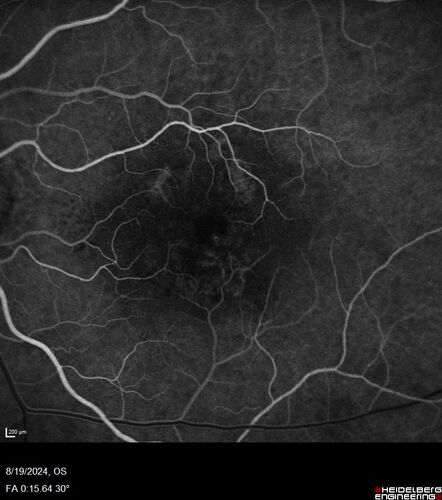 Wet AMD - Occult CNVM and Geographic atrophy
77 year old female with mild vision loss - 20/32 - responded to Avastin
