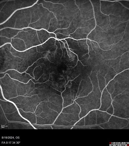 Wet AMD - Occult CNVM and Geographic atrophy
77 year old female with mild vision loss - 20/32 - responded to Avastin
