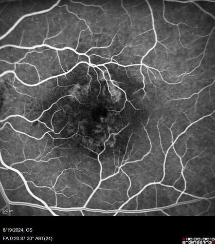 Wet AMD - Occult CNVM and Geographic atrophy
77 year old female with mild vision loss - 20/32 - responded to Avastin
