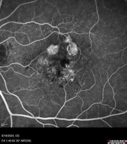 Wet AMD - Occult CNVM and Geographic atrophy
77 year old female with mild vision loss - 20/32 - responded to Avastin
