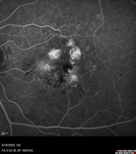 Wet AMD - Occult CNVM and Geographic atrophy
77 year old female with mild vision loss - 20/32 - responded to Avastin
