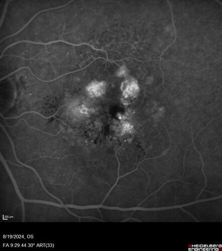 Wet AMD - Occult CNVM and Geographic atrophy
77 year old female with mild vision loss - 20/32 - responded to Avastin
