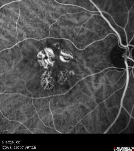 Wet AMD - Occult CNVM and Geographic atrophy
77 year old female with mild vision loss - 20/32 - responded to Avastin
