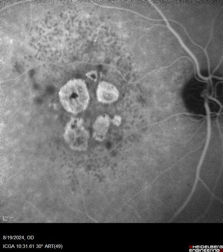 Wet AMD - Occult CNVM and Geographic atrophy
77 year old female with mild vision loss - 20/32 - responded to Avastin
