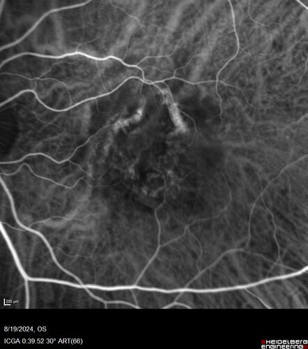 Wet AMD - Occult CNVM and Geographic atrophy
77 year old female with mild vision loss - 20/32 - responded to Avastin

