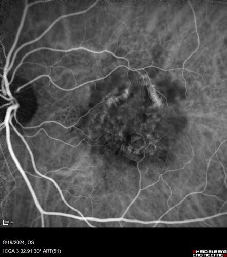Wet AMD - Occult CNVM and Geographic atrophy
77 year old female with mild vision loss - 20/32 - responded to Avastin
