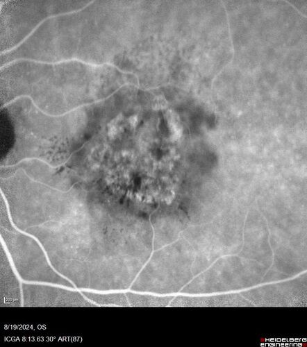 Wet AMD - Occult CNVM and Geographic atrophy
77 year old female with mild vision loss - 20/32 - responded to Avastin
