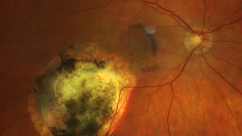 Choroidal Neovascular Membrane (CNVM) secondary to laser scar from TTT for choroidal melanoma 20 years earlier
71-year old female - Vision loss in the right eye for 1 week.  She had transpupillary thermotherapy 20 years ago in the right eye for choroidal melanoma.
VA 4/200 OD, 20/20 OS
