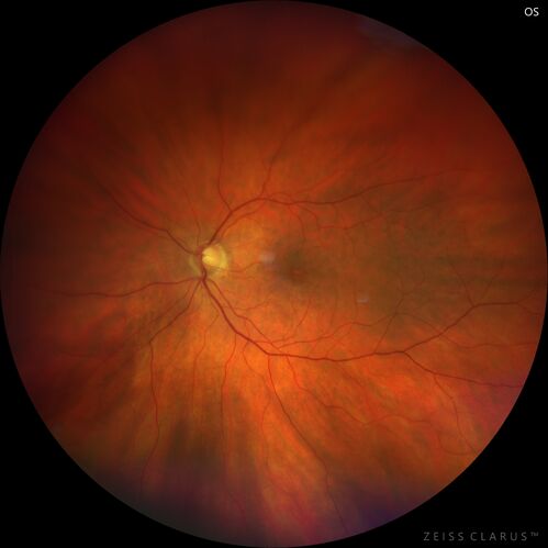 Choroidal Neovascular Membrane (CNVM) secondary to laser scar from TTT for choroidal melanoma 20 years earlier
71-year old female - Vision loss in the right eye for 1 week.  She had transpupillary thermotherapy 20 years ago in the right eye for choroidal melanoma.
VA 4/200 OD, 20/20 OS
