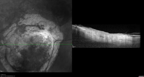 Choroidal Neovascular Membrane (CNVM) secondary to laser scar from TTT for choroidal melanoma 20 years earlier
71-year old female - Vision loss in the right eye for 1 week.  She had transpupillary thermotherapy 20 years ago in the right eye for choroidal melanoma.
VA 4/200 OD, 20/20 OS

