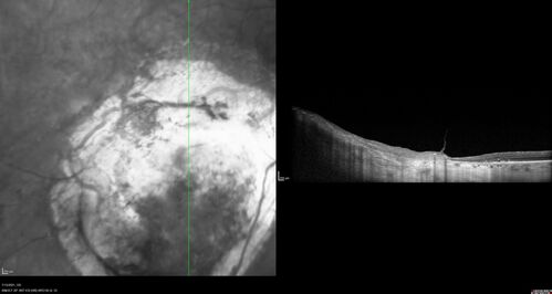 Choroidal Neovascular Membrane (CNVM) secondary to laser scar from TTT for choroidal melanoma 20 years earlier
71-year old female - Vision loss in the right eye for 1 week.  She had transpupillary thermotherapy 20 years ago in the right eye for choroidal melanoma.
VA 4/200 OD, 20/20 OS
