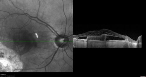 Choroidal Neovascular Membrane (CNVM) secondary to laser scar from TTT for choroidal melanoma 20 years earlier
71-year old female - Vision loss in the right eye for 1 week.  She had transpupillary thermotherapy 20 years ago in the right eye for choroidal melanoma.
VA 4/200 OD, 20/20 OS
