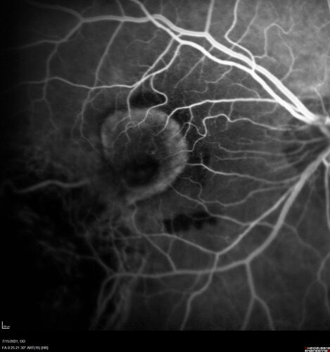 Choroidal Neovascular Membrane (CNVM) secondary to laser scar from TTT for choroidal melanoma 20 years earlier
71-year old female - Vision loss in the right eye for 1 week.  She had transpupillary thermotherapy 20 years ago in the right eye for choroidal melanoma.
VA 4/200 OD, 20/20 OS
