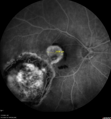 Choroidal Neovascular Membrane (CNVM) secondary to laser scar from TTT for choroidal melanoma 20 years earlier
71-year old female - Vision loss in the right eye for 1 week.  She had transpupillary thermotherapy 20 years ago in the right eye for choroidal melanoma.
VA 4/200 OD, 20/20 OS
