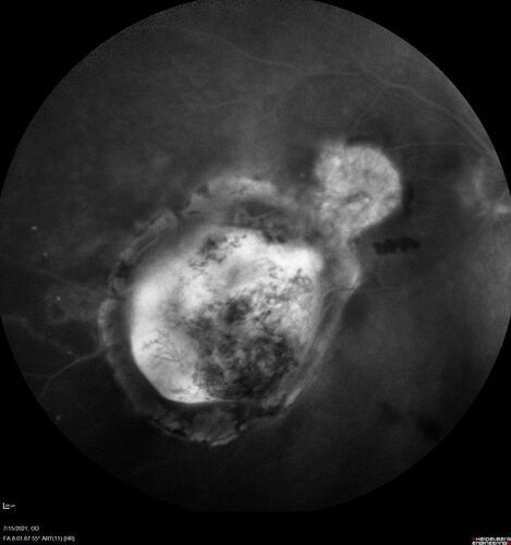Choroidal Neovascular Membrane (CNVM) secondary to laser scar from TTT for choroidal melanoma 20 years earlier
71-year old female - Vision loss in the right eye for 1 week.  She had transpupillary thermotherapy 20 years ago in the right eye for choroidal melanoma.
VA 4/200 OD, 20/20 OS
