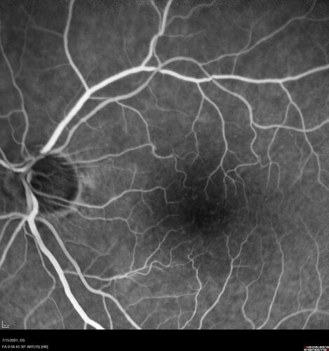 Choroidal Neovascular Membrane (CNVM) secondary to laser scar from TTT for choroidal melanoma 20 years earlier
71-year old female - Vision loss in the right eye for 1 week.  She had transpupillary thermotherapy 20 years ago in the right eye for choroidal melanoma.
VA 4/200 OD, 20/20 OS

