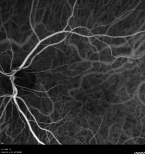 Choroidal Neovascular Membrane (CNVM) secondary to laser scar from TTT for choroidal melanoma 20 years earlier
71-year old female - Vision loss in the right eye for 1 week.  She had transpupillary thermotherapy 20 years ago in the right eye for choroidal melanoma.
VA 4/200 OD, 20/20 OS
