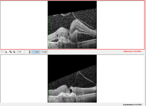 Choroidal Neovascular Membrane (CNVM) secondary to laser scar from TTT for choroidal melanoma 20 years earlier
71-year old female - Vision loss in the right eye for 1 week.  She had transpupillary thermotherapy 20 years ago in the right eye for choroidal melanoma.
VA 4/200 OD, 20/20 OS
