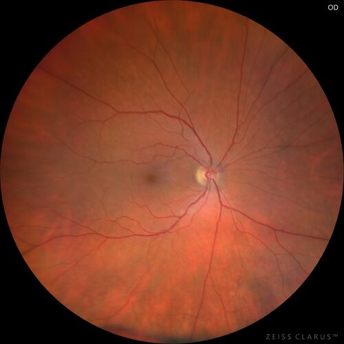 Central Retinal Artery Occlusion
80 Year old man Sudden severe vision loss about 2 weeks ago.  Today he can see light for the first time.  The right eye is OK.  His neuroimaging showed a brain stroke along with the eye stroke.  He was stepping in the shower and the  vision was suddenly worse.  He went, later, to the ER and had a full evaluation.  VA 20/25 right eye, LP left eye
