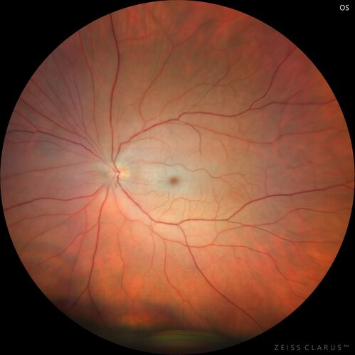 Central Retinal Artery Occlusion
80 Year old man Sudden severe vision loss about 2 weeks ago.  Today he can see light for the first time.  The right eye is OK.  His neuroimaging showed a brain stroke along with the eye stroke.  He was stepping in the shower and the  vision was suddenly worse.  He went, later, to the ER and had a full evaluation.  VA 20/25 right eye, LP left eye
