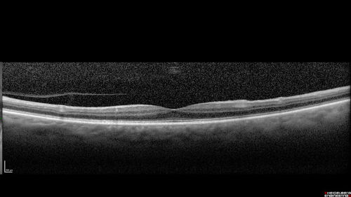 Central Retinal Artery Occlusion
80 Year old man Sudden severe vision loss about 2 weeks ago.  Today he can see light for the first time.  The right eye is OK.  His neuroimaging showed a brain stroke along with the eye stroke.  He was stepping in the shower and the  vision was suddenly worse.  He went, later, to the ER and had a full evaluation.  VA 20/25 right eye, LP left eye
