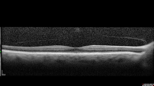 Central Retinal Artery Occlusion
80 Year old man Sudden severe vision loss about 2 weeks ago.  Today he can see light for the first time.  The right eye is OK.  His neuroimaging showed a brain stroke along with the eye stroke.  He was stepping in the shower and the  vision was suddenly worse.  He went, later, to the ER and had a full evaluation.  VA 20/25 right eye, LP left eye
