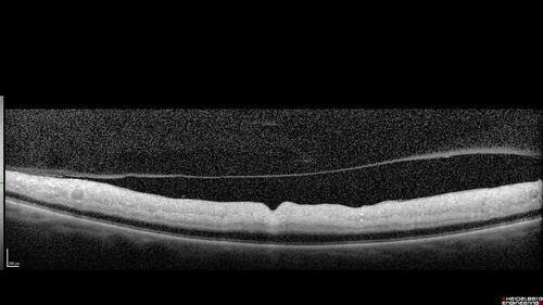 Central Retinal Artery Occlusion
80 Year old man Sudden severe vision loss about 2 weeks ago.  Today he can see light for the first time.  The right eye is OK.  His neuroimaging showed a brain stroke along with the eye stroke.  He was stepping in the shower and the  vision was suddenly worse.  He went, later, to the ER and had a full evaluation.  VA 20/25 right eye, LP left eye
