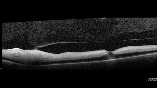 Central Retinal Artery Occlusion
80 Year old man Sudden severe vision loss about 2 weeks ago.  Today he can see light for the first time.  The right eye is OK.  His neuroimaging showed a brain stroke along with the eye stroke.  He was stepping in the shower and the  vision was suddenly worse.  He went, later, to the ER and had a full evaluation.  VA 20/25 right eye, LP left eye
