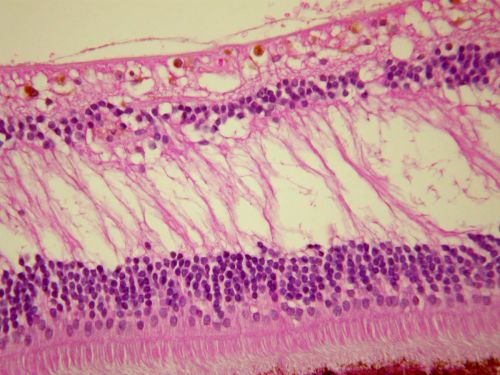 Pathology - Central Retinal Artery Occlusion - 6 weeks old - Inner Retinal Atrophy
patient died about 6 to 8 weeks after the artery occlusion, and he had no history of glaucoma. The inner retina atrophy, which looks very similar to that caused by COAG, is due to recent infarct. 
