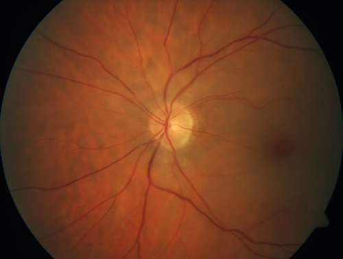 Acute Central Retinal Artery Occlusion
1 day of vision loss 79 year old man to HM.  NVG developed 2 months later.
