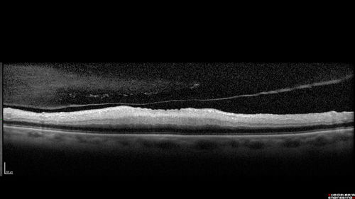 Acute Central Retinal Artery Occlusion
1 day of vision loss 79 year old man to HM.  NVG developed 2 months later.
