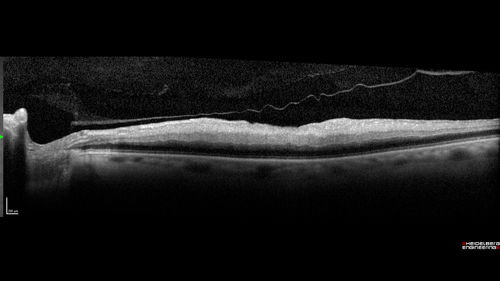 Acute Central Retinal Artery Occlusion
1 day of vision loss 79 year old man to HM.  NVG developed 2 months later.
