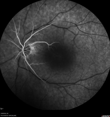 Acute Central Retinal Artery Occlusion
1 day of vision loss 79 year old man to HM.  NVG developed 2 months later.

