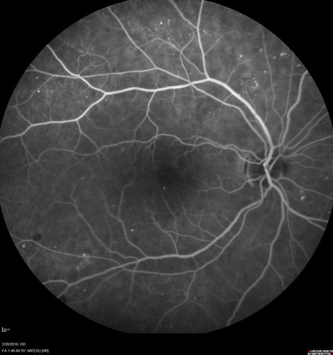 Acute Central Retinal Artery Occlusion
1 day of vision loss 79 year old man to HM.  NVG developed 2 months later.
