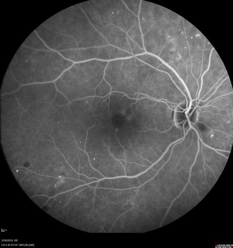 Acute Central Retinal Artery Occlusion
1 day of vision loss 79 year old man to HM.  NVG developed 2 months later.
