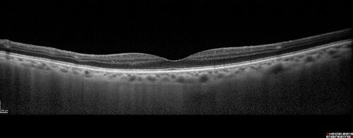 Central retinal artery occlusion and paracentral acute middle maculopathy and emboli
86 year old female with sudden vision loss a week ago and imaging shows PAMM lesions and emboli.  Her vision is 20/200 in the left eye
