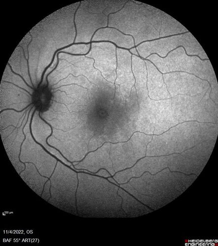 Central retinal artery occlusion and paracentral acute middle maculopathy and emboli
86 year old female with sudden vision loss a week ago and imaging shows PAMM lesions and emboli.  Her vision is 20/200 in the left eye
