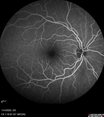 Central retinal artery occlusion and paracentral acute middle maculopathy and emboli
86 year old female with sudden vision loss a week ago and imaging shows PAMM lesions and emboli.  Her vision is 20/200 in the left eye
