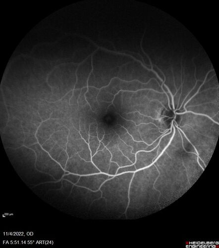 Central retinal artery occlusion and paracentral acute middle maculopathy and emboli
86 year old female with sudden vision loss a week ago and imaging shows PAMM lesions and emboli.  Her vision is 20/200 in the left eye
