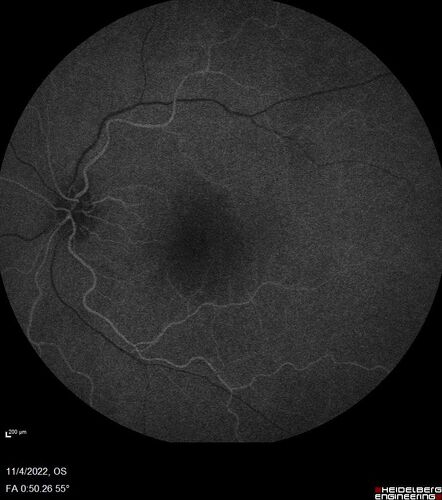 Central retinal artery occlusion and paracentral acute middle maculopathy and emboli
86 year old female with sudden vision loss a week ago and imaging shows PAMM lesions and emboli.  Her vision is 20/200 in the left eye

