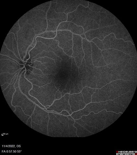 Central retinal artery occlusion and paracentral acute middle maculopathy and emboli
86 year old female with sudden vision loss a week ago and imaging shows PAMM lesions and emboli.  Her vision is 20/200 in the left eye
