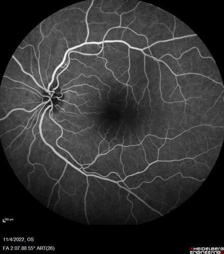 Central retinal artery occlusion and paracentral acute middle maculopathy and emboli
86 year old female with sudden vision loss a week ago and imaging shows PAMM lesions and emboli.  Her vision is 20/200 in the left eye
